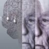 Mais de 99% dos testes de drogas para Alzheimer falharam