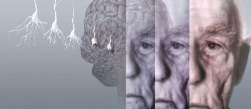 Mais de 99% dos testes de drogas para Alzheimer falharam