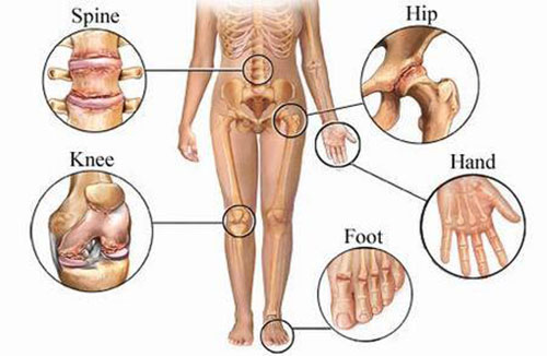 Pesquisa revela um pouco mais sobre as causas da artrose