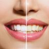 Clareadores dentais terão prescrição para venda, determina Anvisa