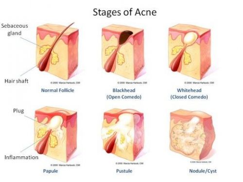 Roacutan: perigos e benefícios no uso para acne