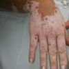 Medicamento traz pigmento da pele de volta a pessoas com vitiligo