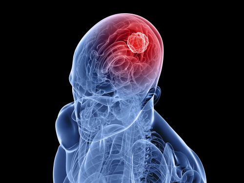 Vacina contra tumor cerebral estende vida de doentes terminais